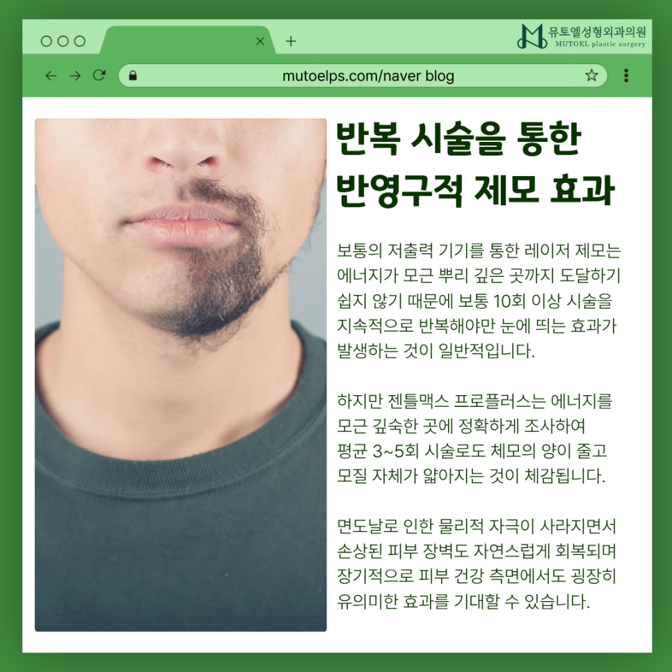 아침마다 반복되는 제모 스트레스, 전문의가 직접 경험한 젠틀맥스 프로플러스 관련 이미지 5