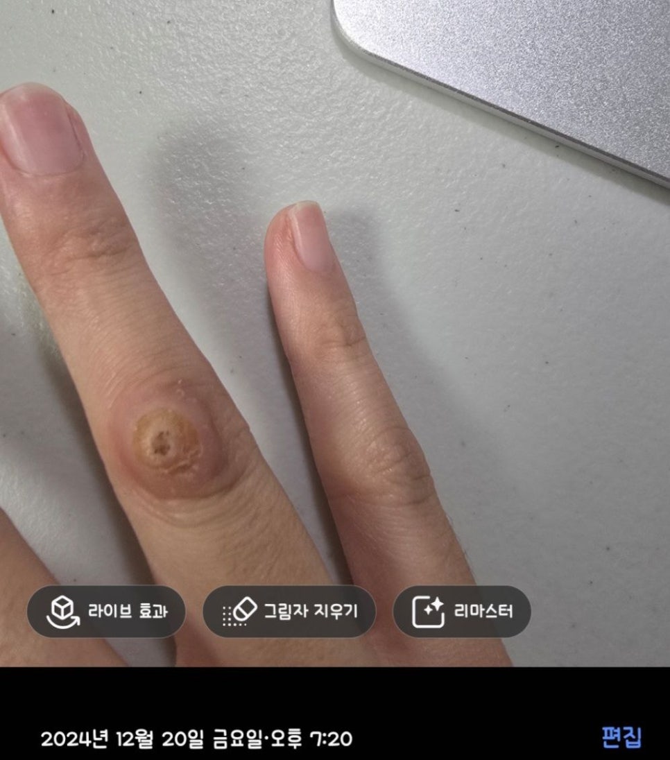 Cryotherapy Review for Finger Warts and a Video of the Actual Treatment Process Included image 12