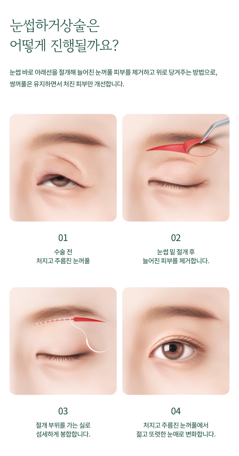 For Sharpening a Sagging Eye Shape with Brow Lift Surgery image 4