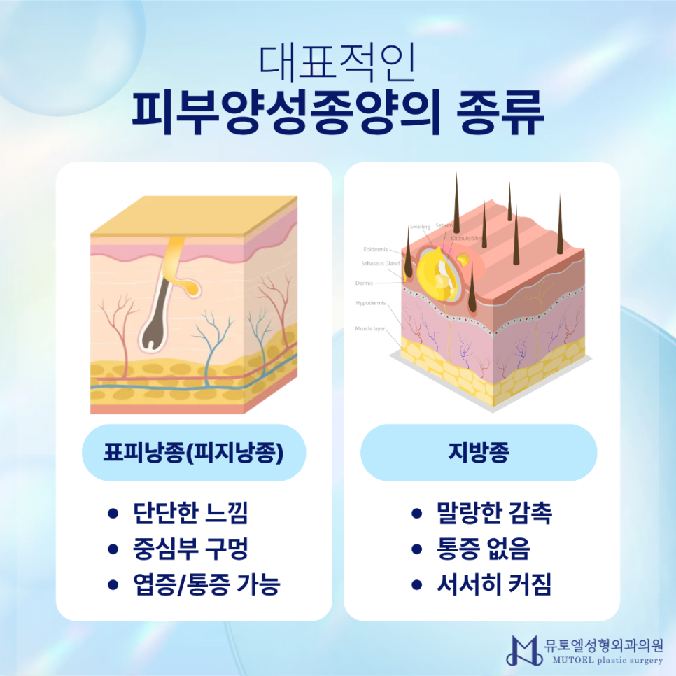 Skin Benign Tumors: Characteristics by Type and a Professional Guide to Accurate Treatment image 3