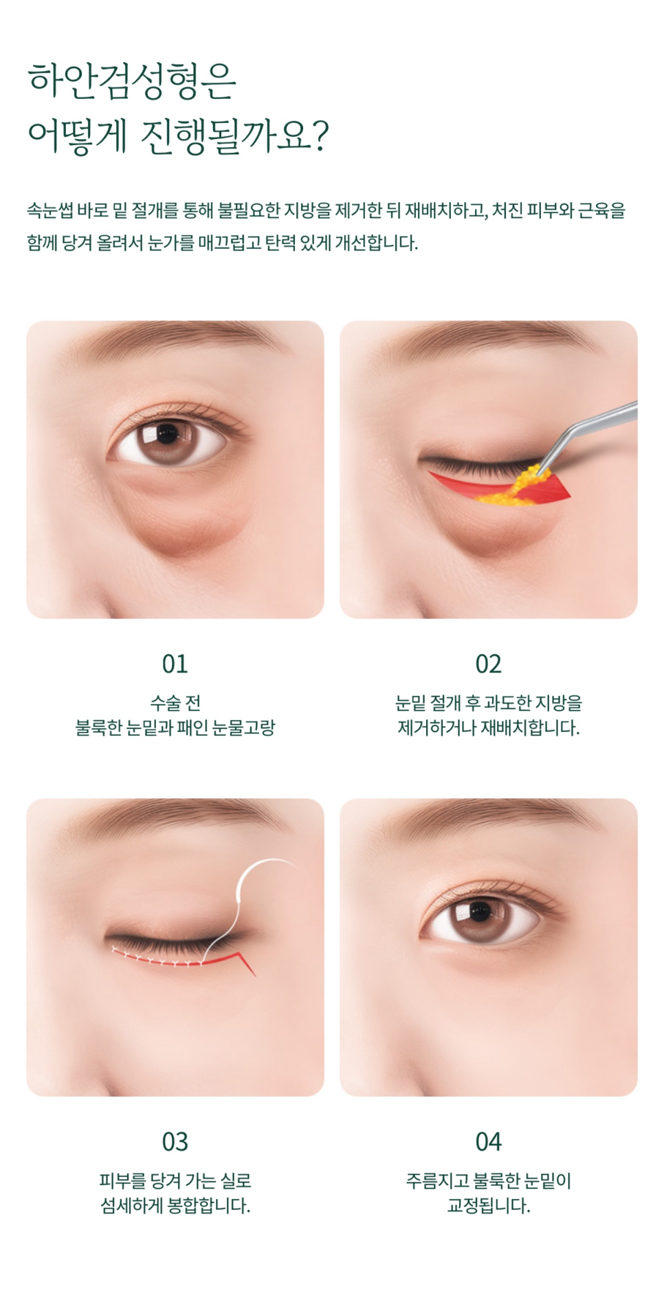 하안검수술 부작용 걱정 없이 젊음을 되찾고 싶다면 관련 이미지 4