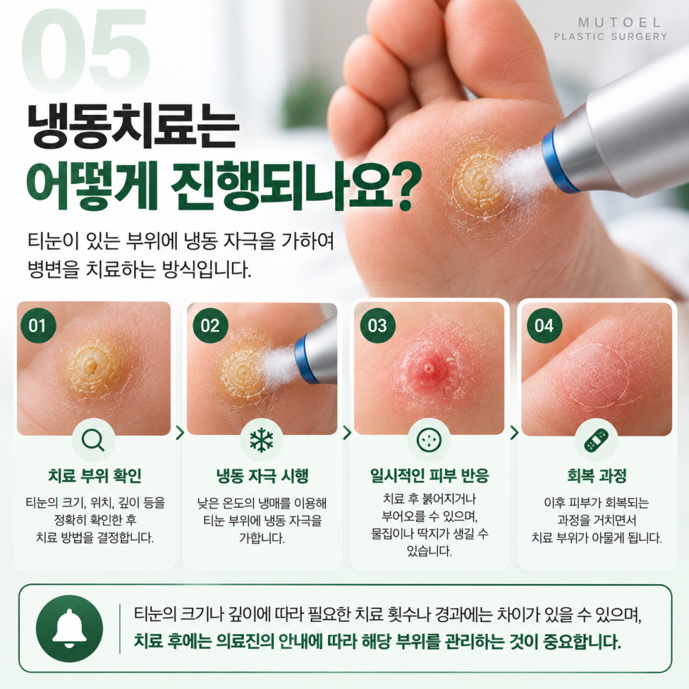 손, 발에 생긴 티눈 냉동치료로 제거할 수 있을까? 보험 적용까지 알아보기 관련 이미지 5