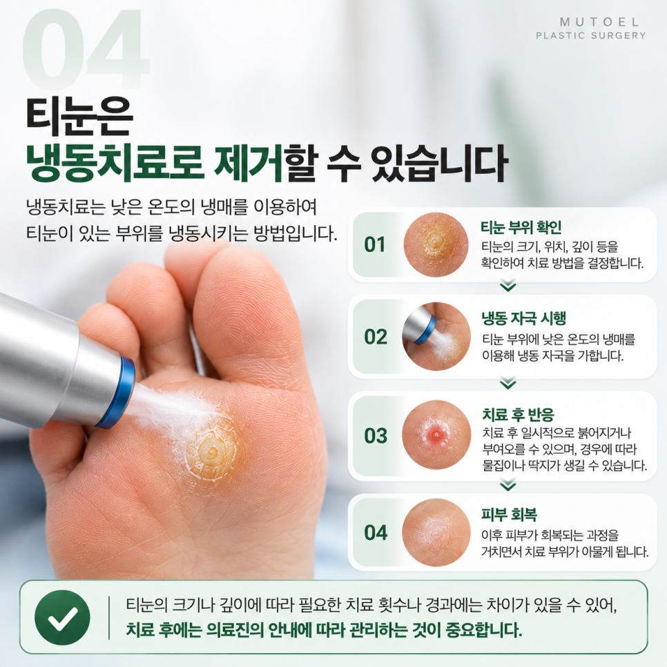 손, 발에 생긴 티눈 냉동치료로 제거할 수 있을까? 보험 적용까지 알아보기 관련 이미지 4