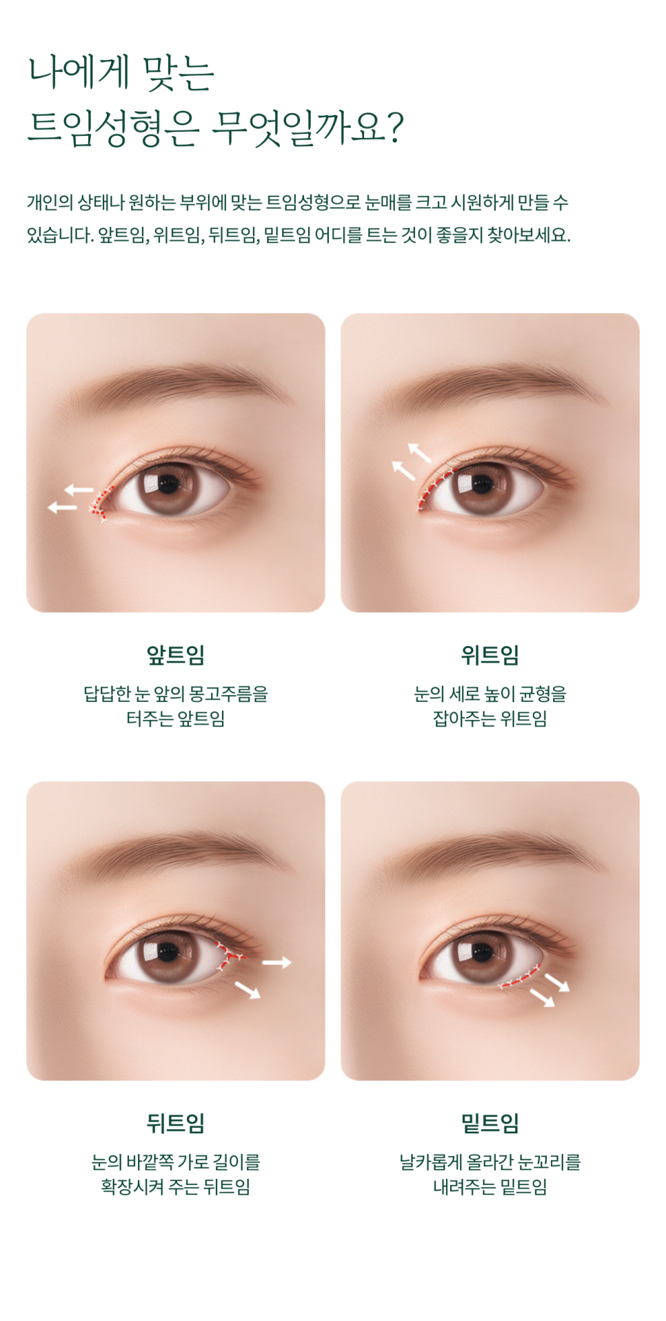 여의도성형외과 트임성형을 통해 눈매의 개방감을 관련 이미지 4