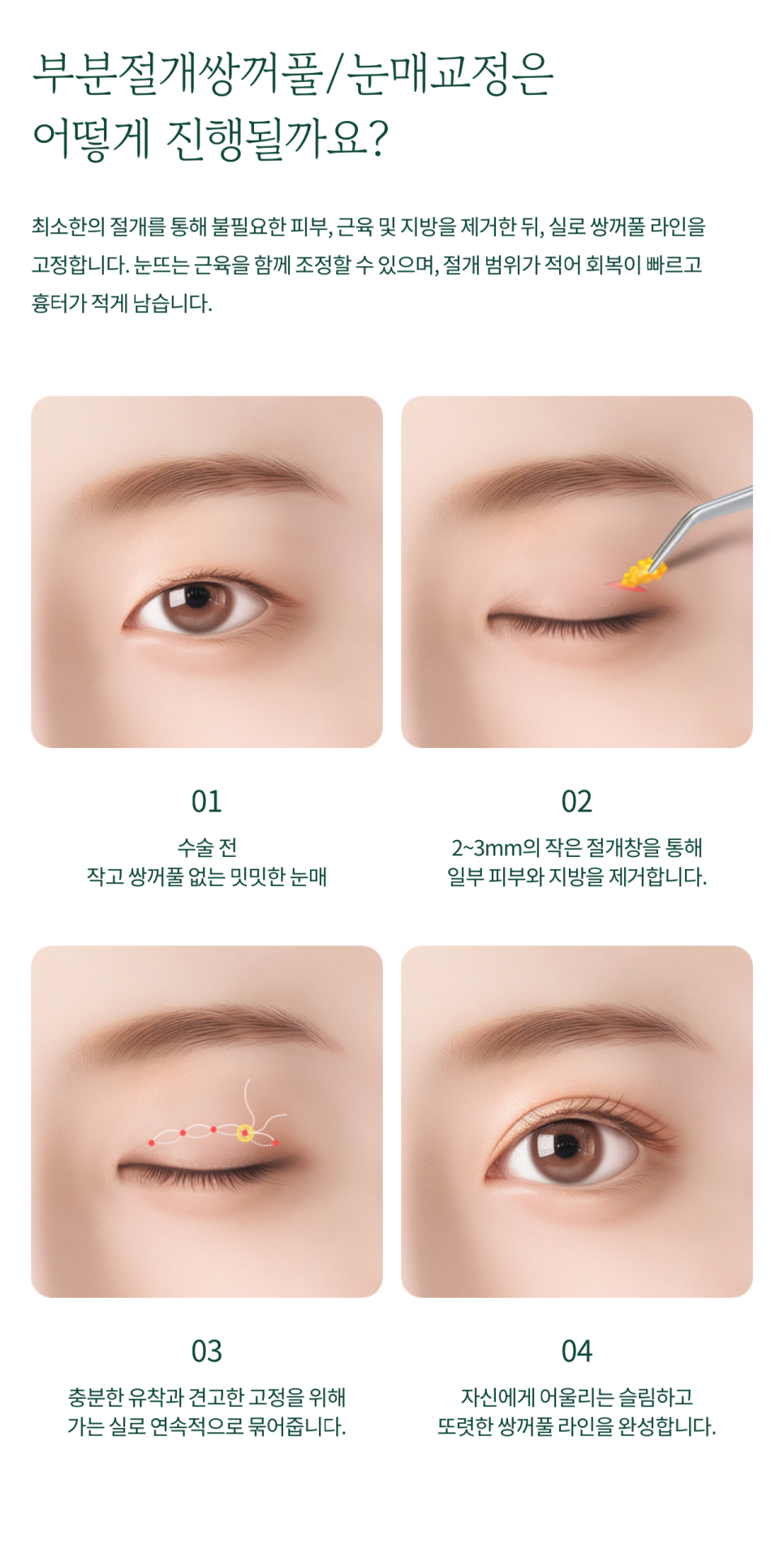 Subincisional Double Eyelid Surgery with Precise Technique at Sin-Yongsan Plastic Surgery image 3