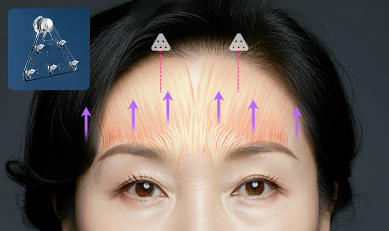 Endotine Endoscopic Forehead Lift for Efficient, Long-Lasting Results image 2