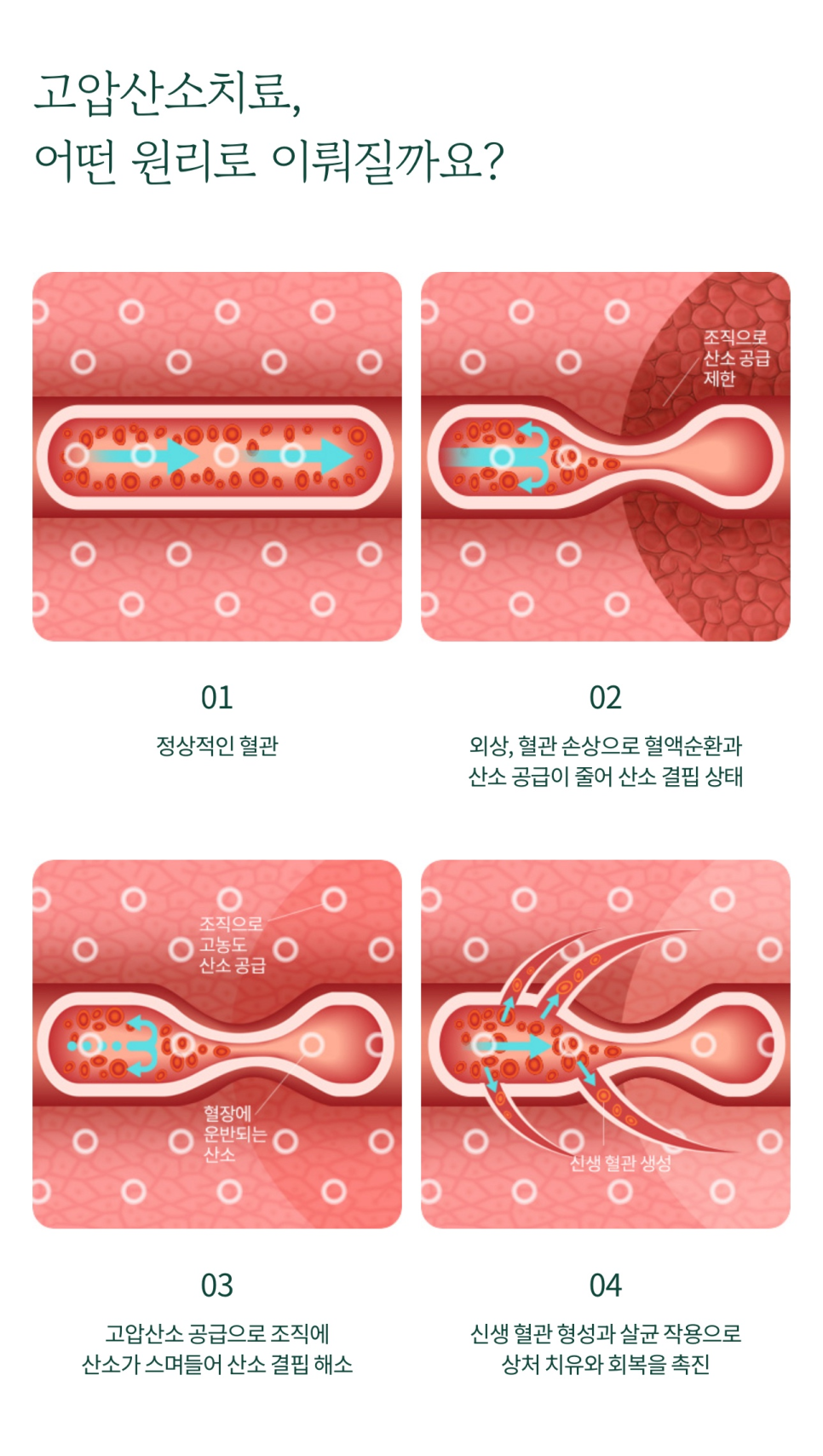 고압산소치료를 통해 빠른 회복을 관련 이미지 4