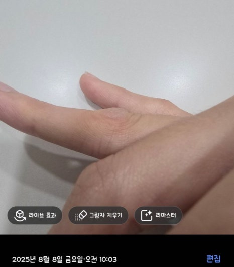 Cryotherapy Review for Finger Warts and a Video of the Actual Treatment Process Included image 14