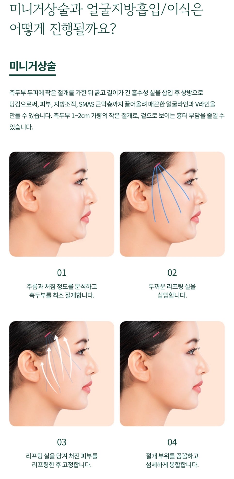 미니거상 수술 피부의 탄력을 더하기 위해 관련 이미지 5