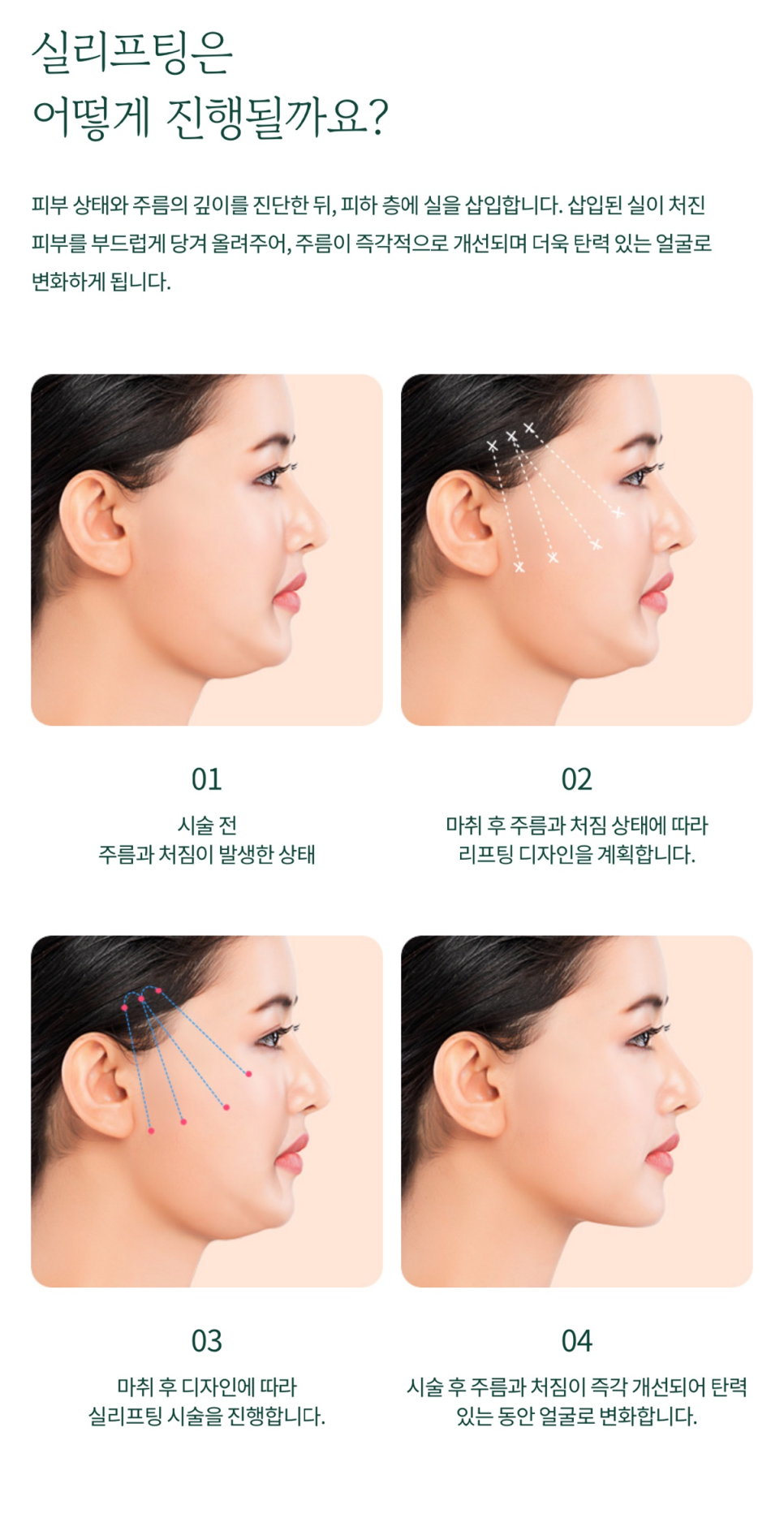Achieve a Natural, Youthful Look Through Thread Lifting at Yongsan Plastic Surgery image 5