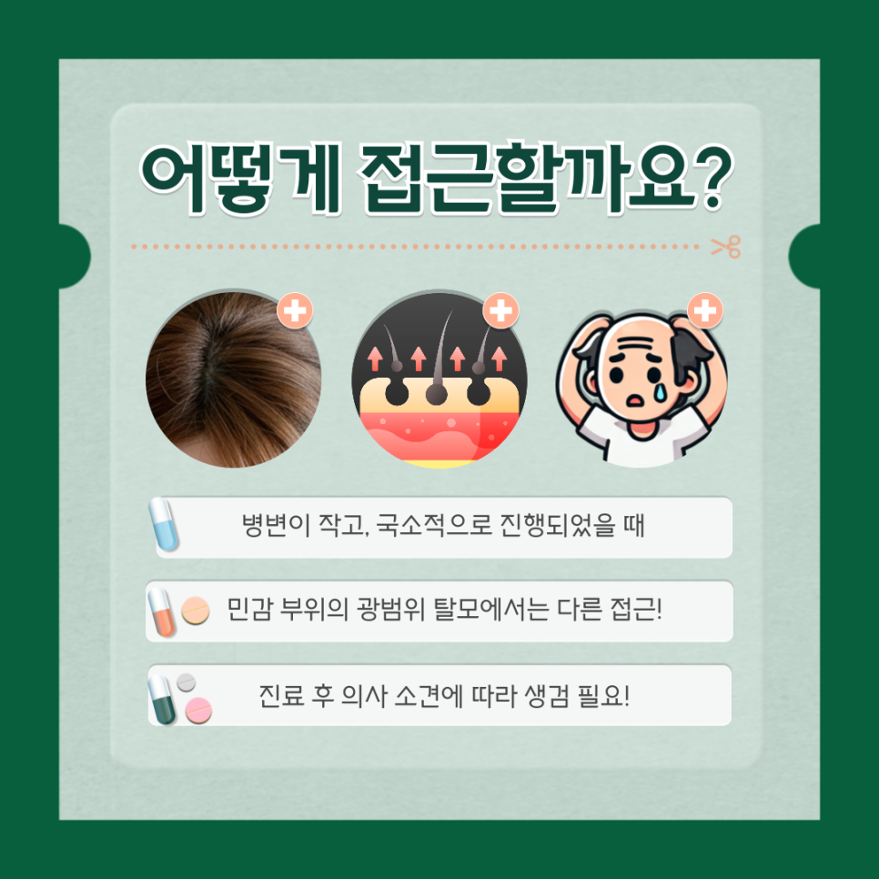 원형 탈모, 국소 스테로이드 주사로 근본적 해결을 관련 이미지 2