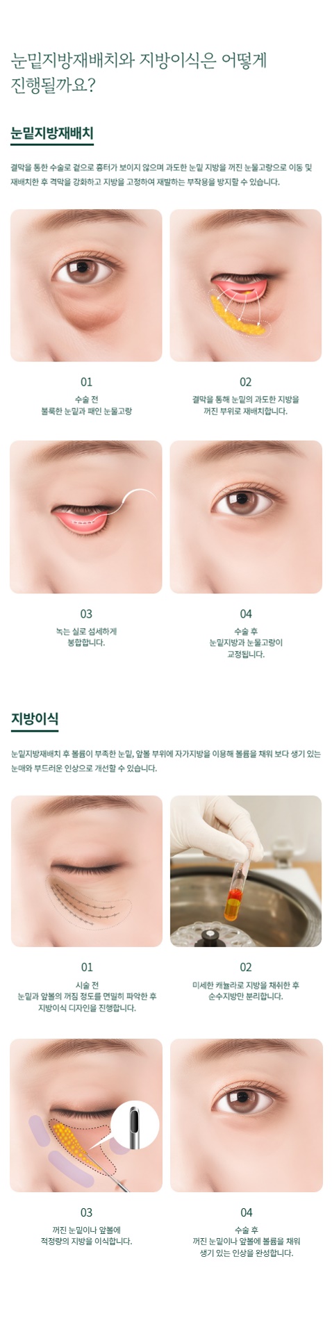 Bright and Youthful with Under-Eye Fat Repositioning and Fat Grafting image 2