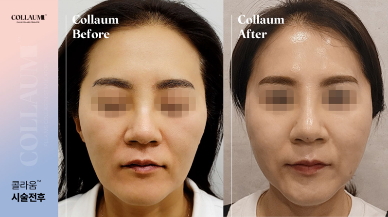True Recovery from Within the Skin Through Colaum Collagen Booster image 3