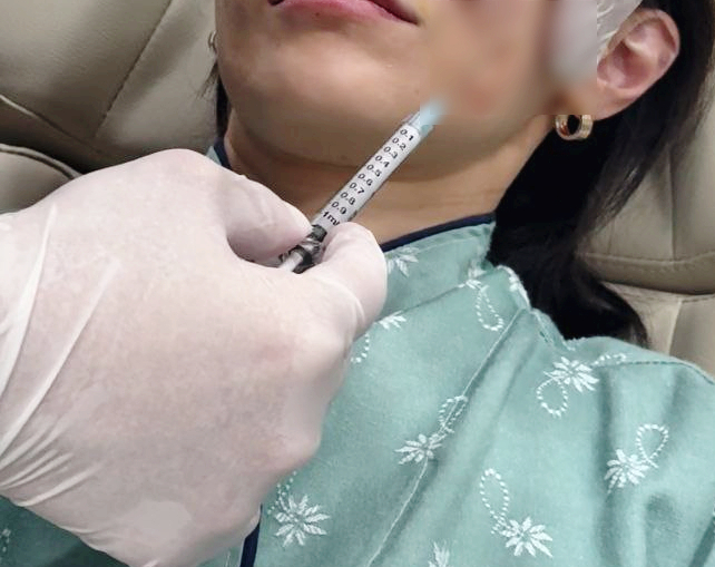 Types of Hollow Cheek Treatments and Restoring Volume with Radiesse image 13