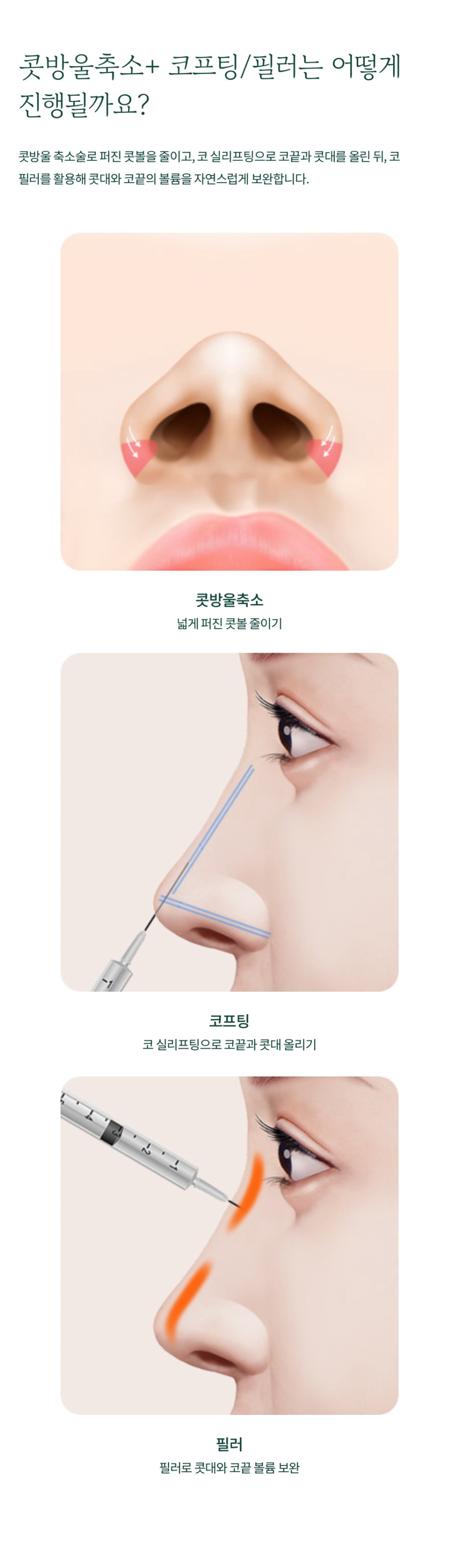 Creating a Harmonious Impression with Nostril Reduction and Nose Thread Lifting/Filler image 5