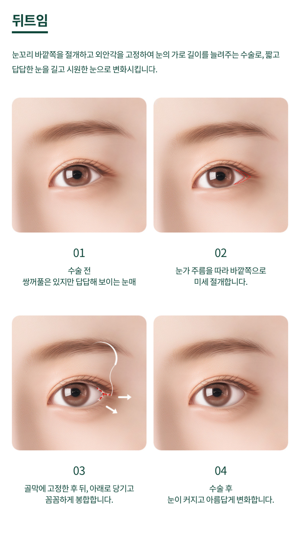 여의도성형외과 트임성형을 통해 눈매의 개방감을 관련 이미지 5