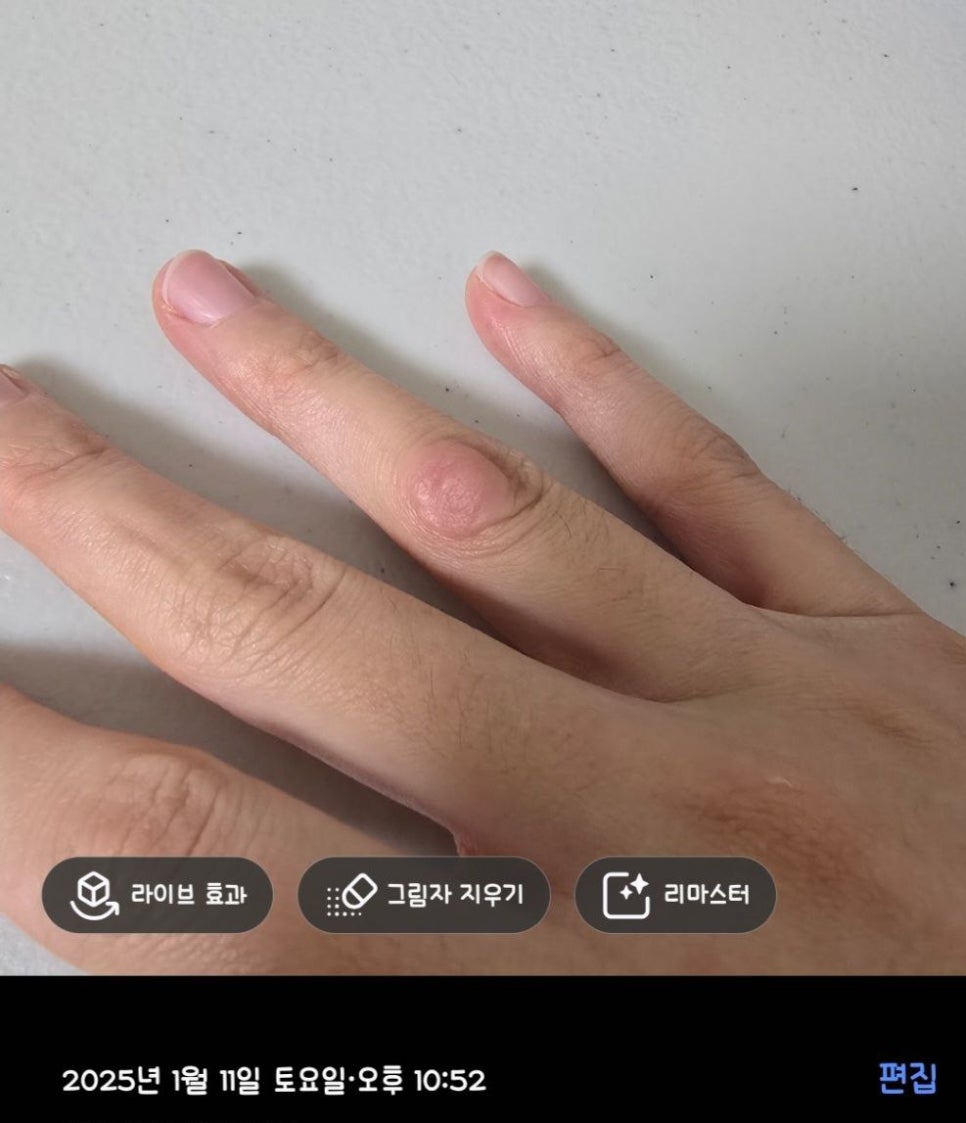 Cryotherapy Review for Finger Warts and a Video of the Actual Treatment Process Included image 4