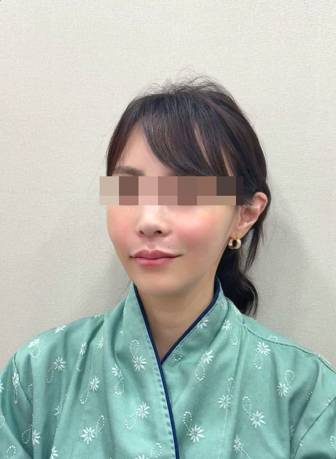Types of Hollow Cheek Treatments and Restoring Volume with Radiesse image 16