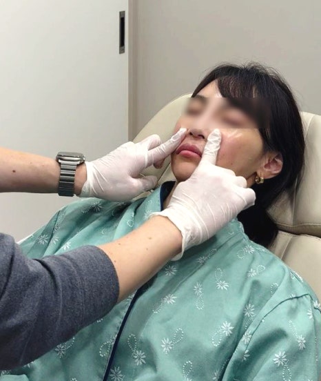 Types of Hollow Cheek Treatments and Restoring Volume with Radiesse image 15