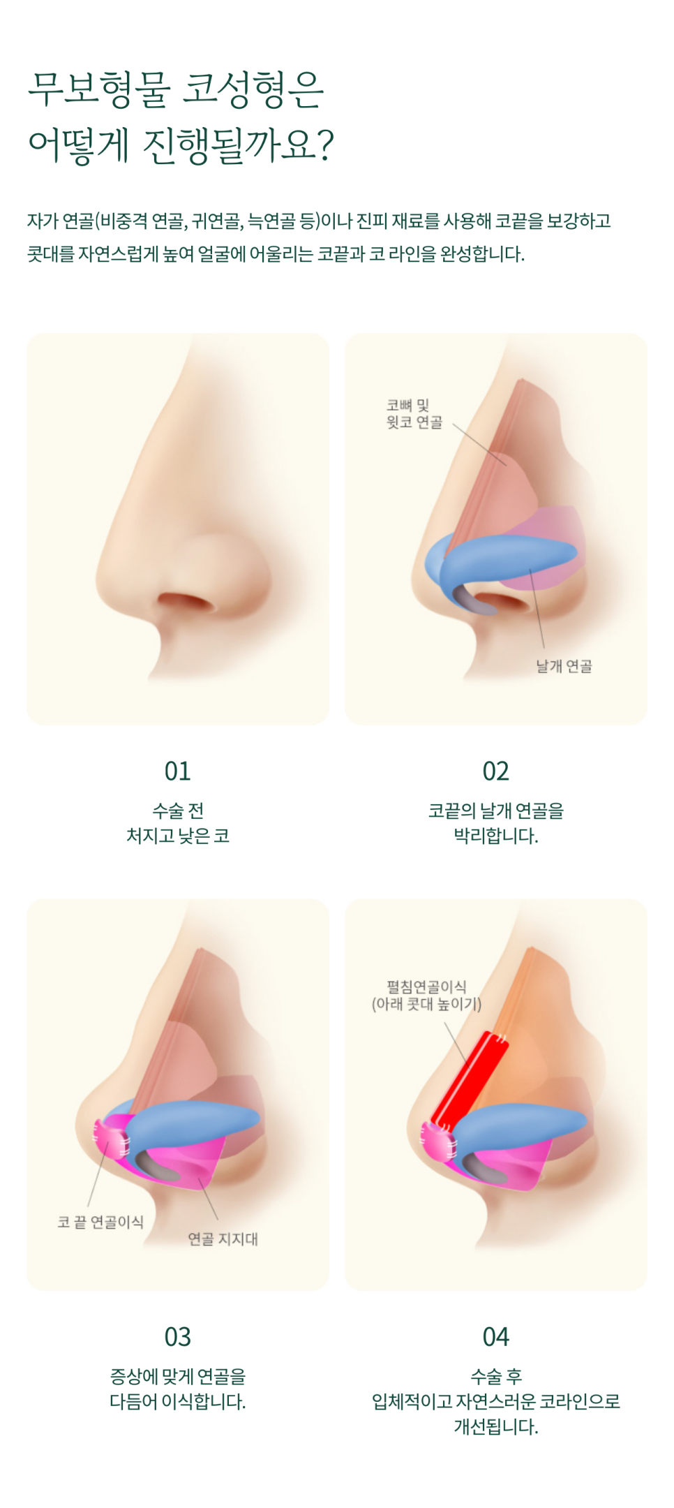 용산성형외과 무보형물 코성형으로 자연스러움을 함께 관련 이미지 4