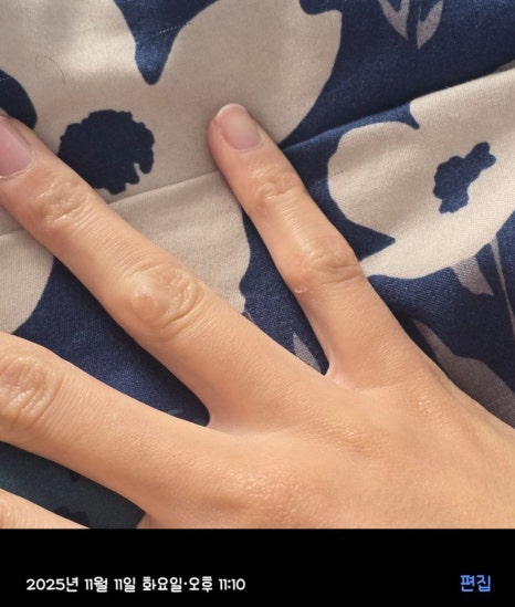 Cryotherapy Review for Finger Warts and a Video of the Actual Treatment Process Included image 15