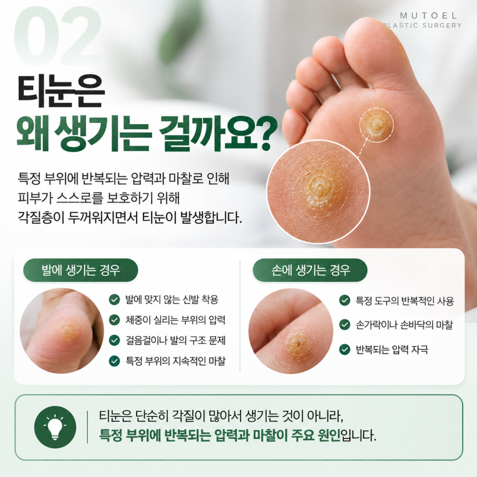 손, 발에 생긴 티눈 냉동치료로 제거할 수 있을까? 보험 적용까지 알아보기 관련 이미지 2