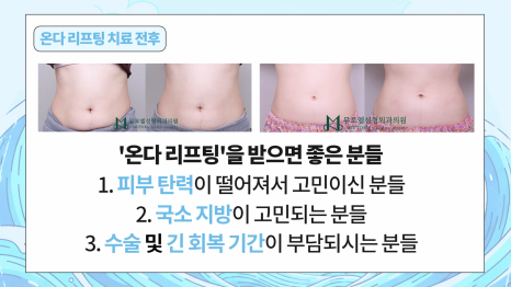 Simultaneous Fat Breakdown and Skin Firming Improvement with Onda Lifting image 17