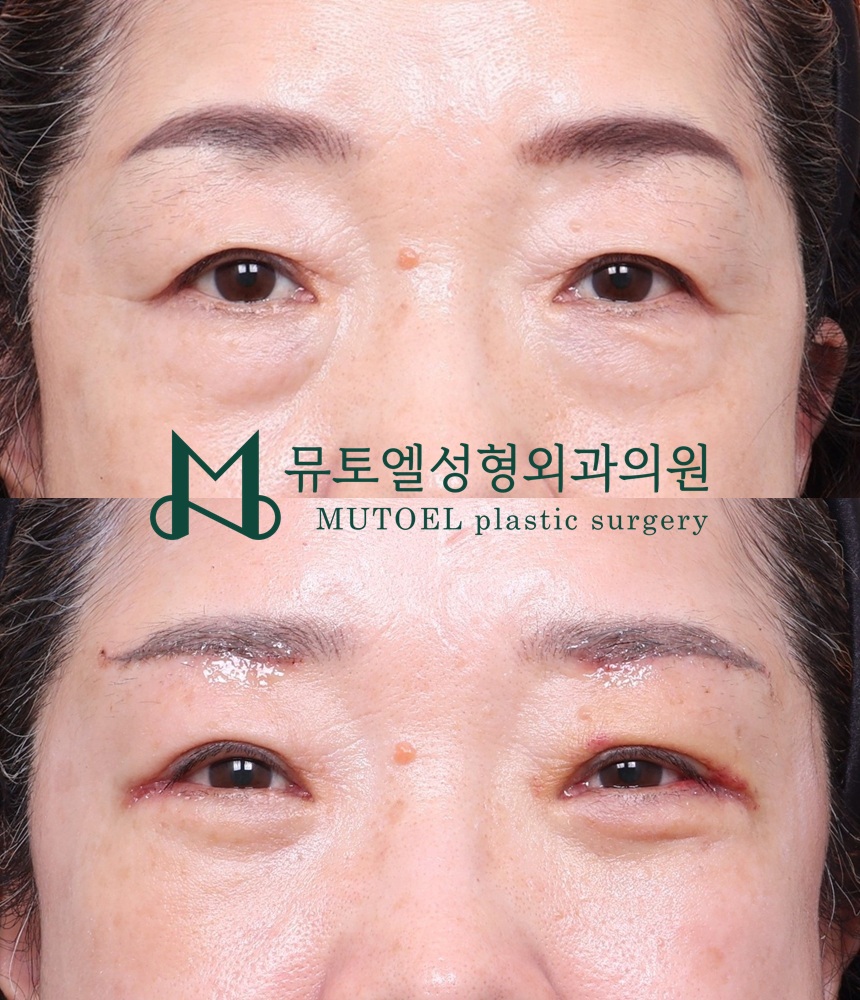 Under-Eye Fat Repositioning and Lower Blepharoplasty: A Choice That Improves Your Impression image 6
