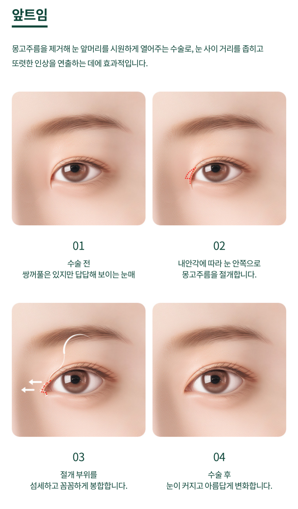 여의도성형외과 트임성형을 통해 눈매의 개방감을 관련 이미지 6