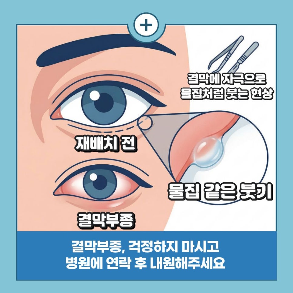 공포를 확신으로 바꾸는 시간, 안전한 눈밑 수술 가이드 관련 이미지 4