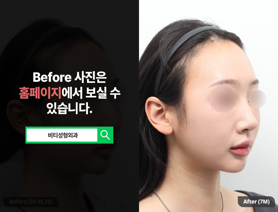 Filler Side Effect: A Receding Chin? Improved with Contouring Surgery | 7-Month Real Review image 2