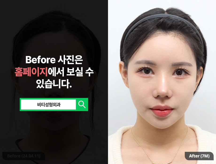 윤곽3종, 살 빼고 수술해야 더 예쁜 라인 나오는 이유 관련 이미지 1