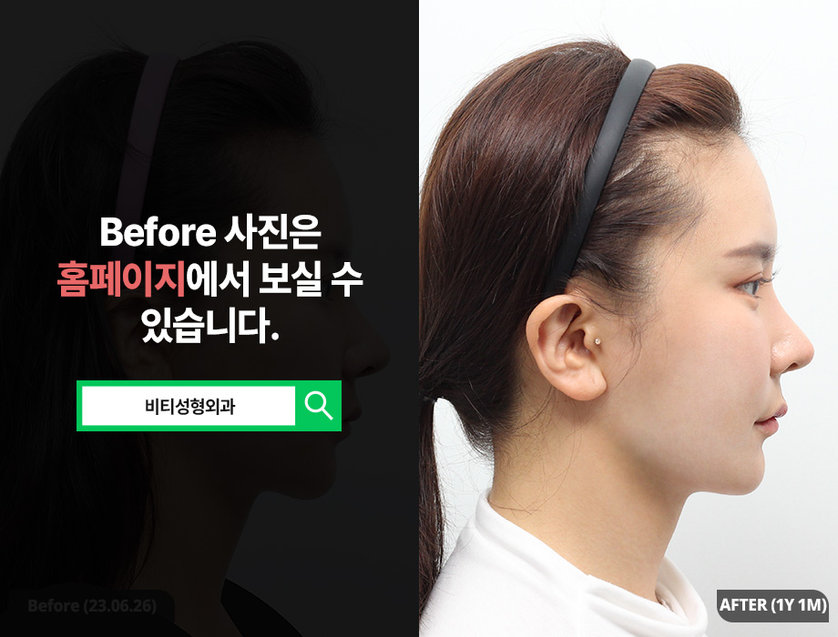 A Real Review 1 Year After Surgery for Minimizing Cheekbone Reduction Side Effects image 3