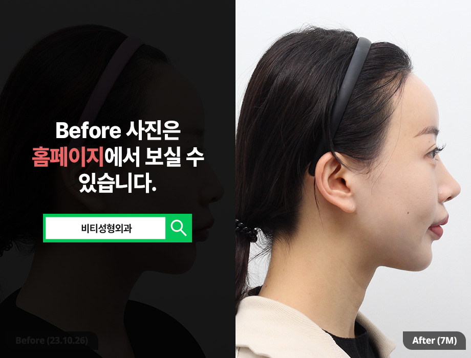 I Changed My Face Shape with Square Jaw + Chin Surgery (Real Review of Facial Contouring 2 Procedures) image 3