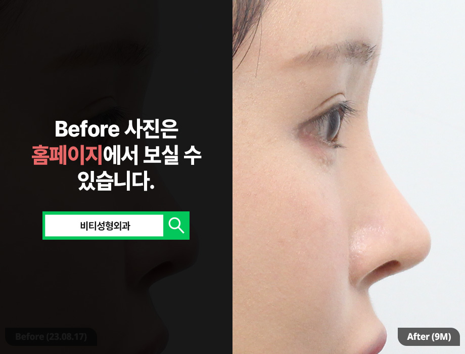 코재수술, 왜 자가늑연골을 사용할까? 관련 이미지 1