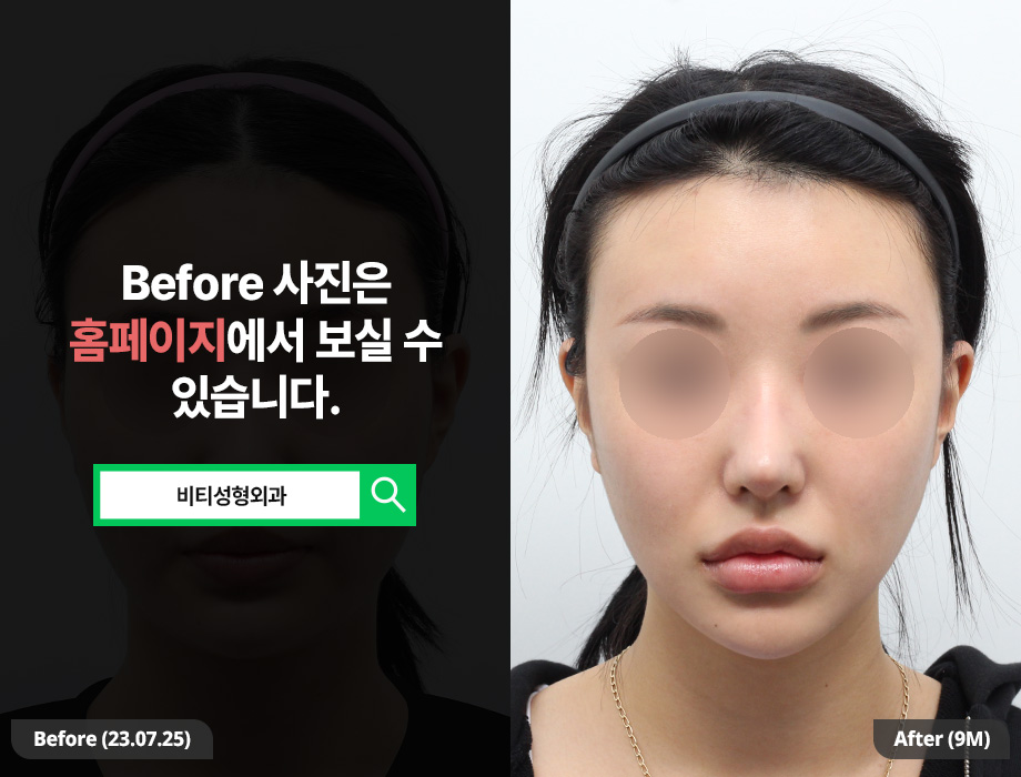 얼굴 지흡까지 해야 갸름해지는 이유, 9개월 변화로 증명 관련 이미지 1