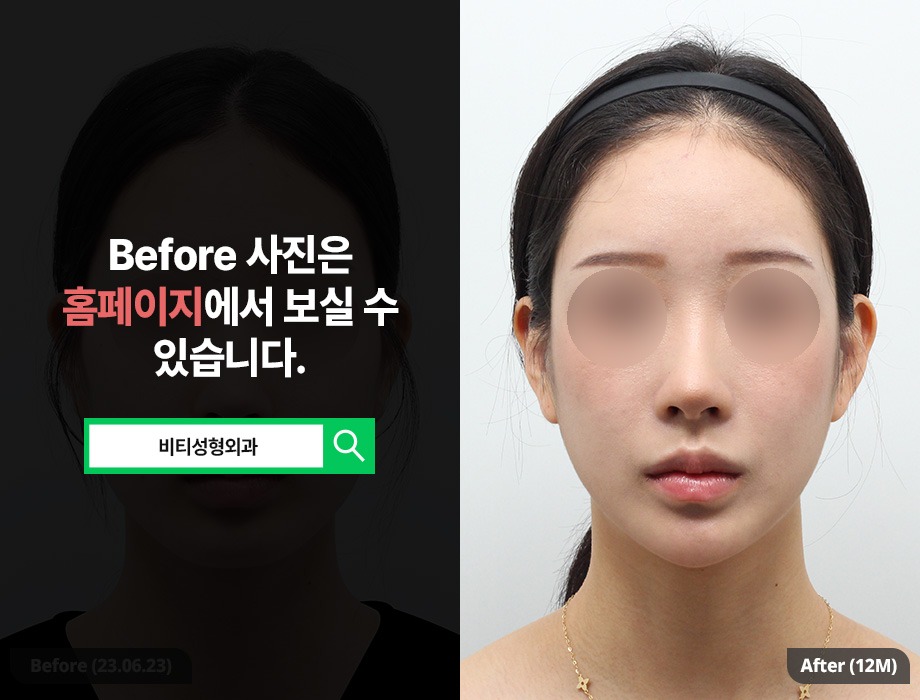 전후차이 확실한 안면윤곽 고려하고 있다면 관련 이미지 1