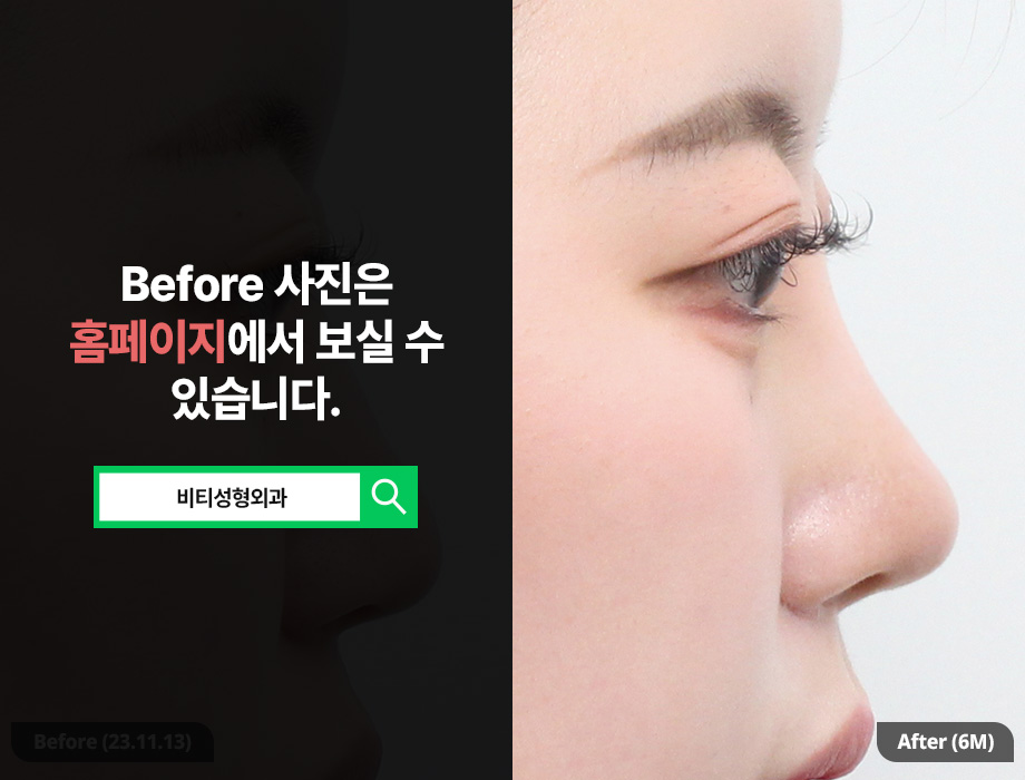 귀연골 코성형, 자연스러움을 원한다면? 6개월 리얼후기 관련 이미지 1
