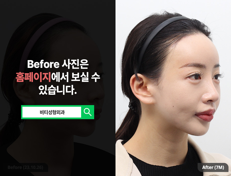 I Changed My Face Shape with Square Jaw + Chin Surgery (Real Review of Facial Contouring 2 Procedures) image 2