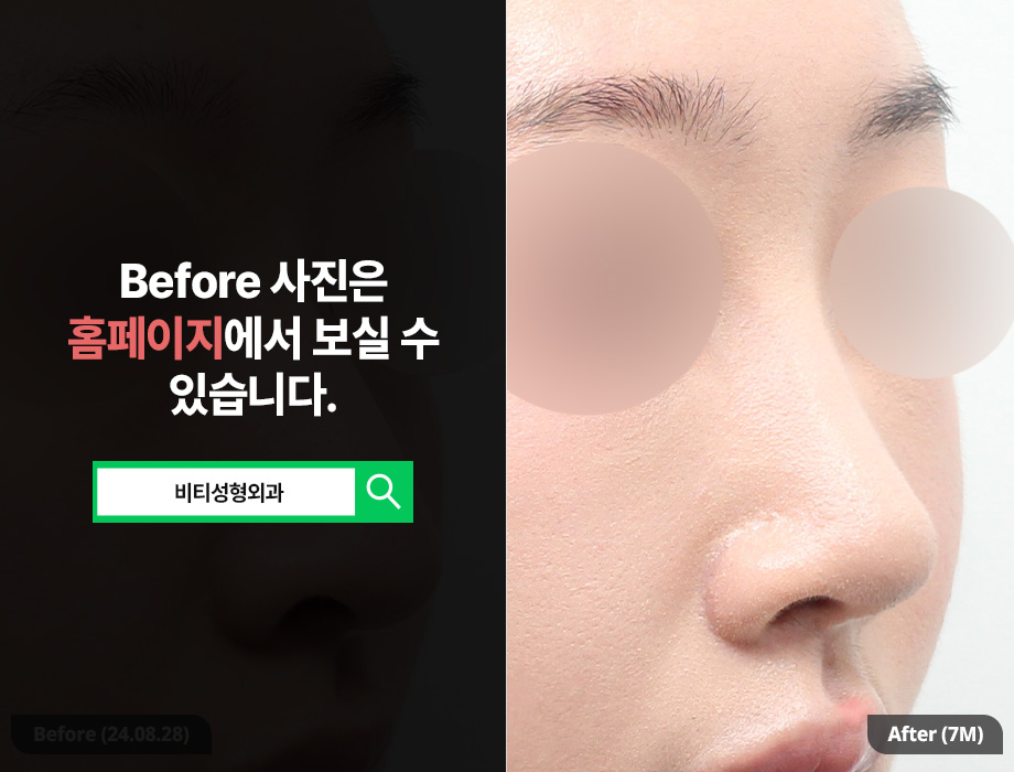 Non-implant Rhinoplasty, Novo Nose Surgery (Hump Nose + Bulbous Nose) 7-Month Real Review image 2