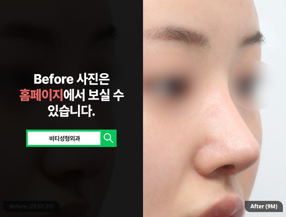 코 성형 후 코끝 처짐/떨어짐으로 재수술 고려한다면 관련 이미지 2
