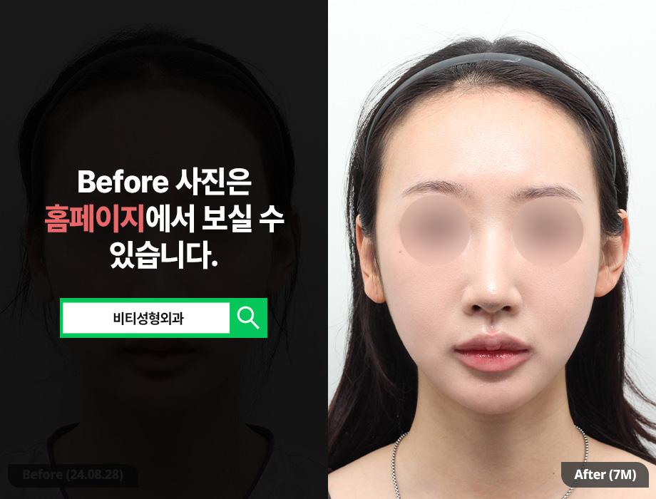 Filler Side Effect: A Receding Chin? Improved with Contouring Surgery | 7-Month Real Review image 1