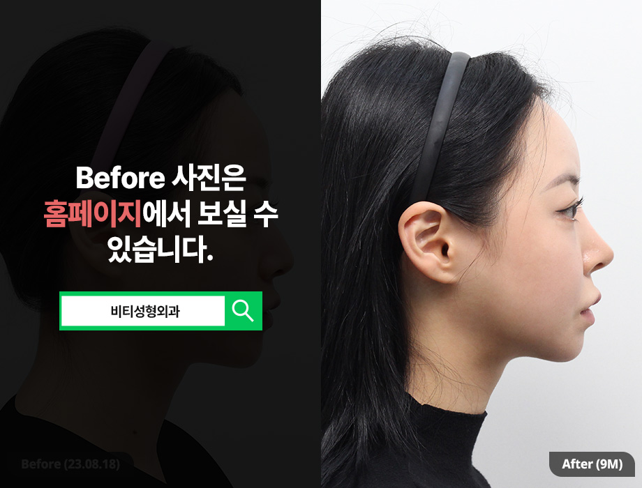 입체적인 얼굴형 만들기, 윤곽 3종 수술 전 꼭 알아야 할 것들 관련 이미지 3