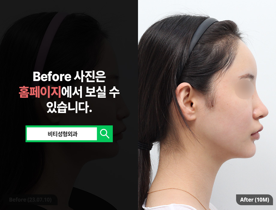 윤곽3종 수술 시 주의할 점 10개월 전후사진 관련 이미지 3