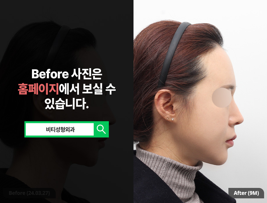 얼굴이 작은데 윤곽수술 해도 되나요? 작고 각진 얼굴 9개월 후기 관련 이미지 3
