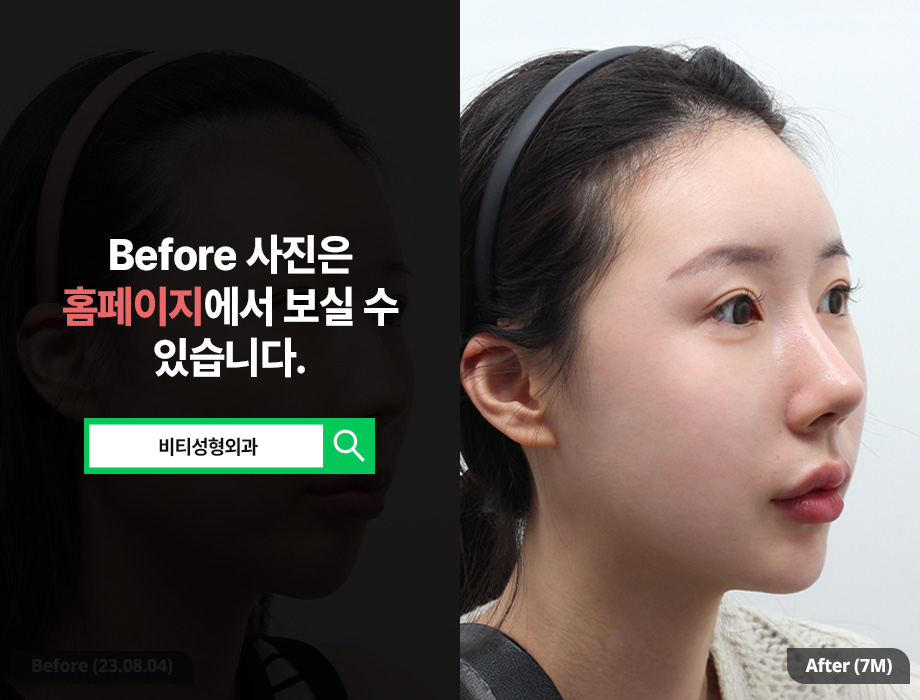 안면윤곽으로 입체감까지 챙기는 "무턱 교정" 관련 이미지 2