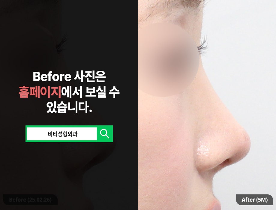 코성형 후 들창코? 자가늑+무보형물로 코재수술 관련 이미지 1