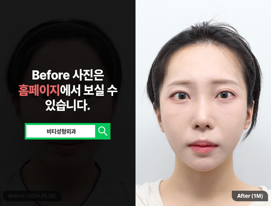 [비티성형외과] 턱끝 필러 vs 윤곽 3종, 현명한 선택 기준 & 후기 관련 이미지 1