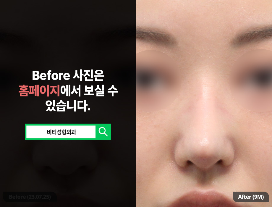 코 성형 후 코끝 처짐/떨어짐으로 재수술 고려한다면 관련 이미지 3