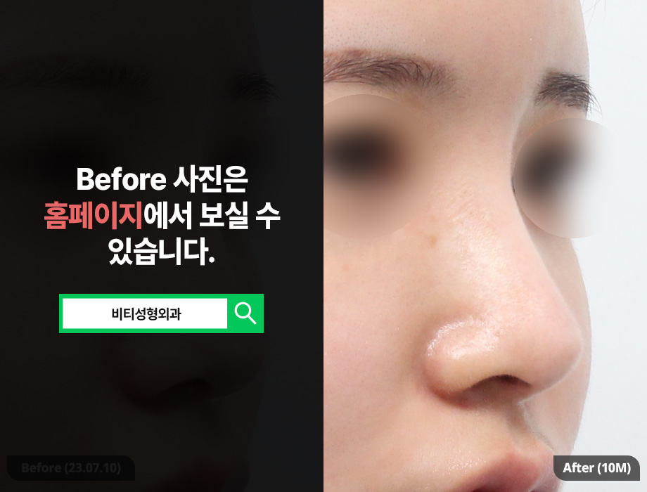 Before-and-after comparison of raising a low, drooping nose over 10 months✨ (ft. donated rib cartilage, columella lifting) image 2